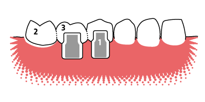 Die Freiendbrücke mit einem frei endenden Brückenglied Veranschaulichung der Funktionsweise einer 3-gliedrigen Freiend-Zahnbrücke