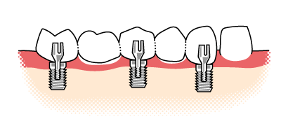 Aufbau einer 5-gliedrigen Implantatbrücke Veranschaulichung der des Aufbaus einer Implantatrücke auf zwei Implantaten und einem eigenen Zahn